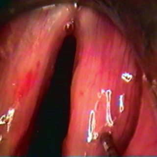016 - Inspiratory laryngeal dystonia in adduction.
