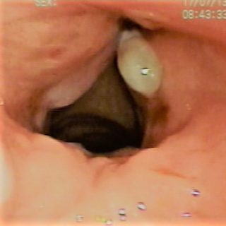 017 - Pseudopólipo que asienta en comisura y tercio anterior de la cuerda vocal derecha.