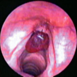 020 - Large chordal hematoma.