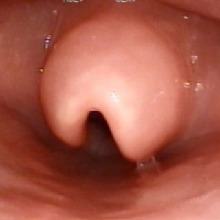 021 - Epiglottitis.