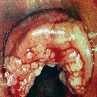 022 - Papilloma on the epiglottis.