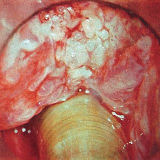 023 - Cáncer papilar verrugoso de la epiglotis.