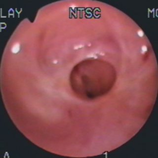 189 - Tracheal stenosis in double diaphragm
