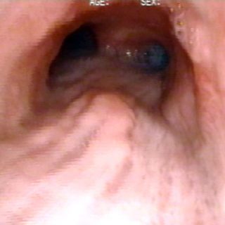285 - Carcinoma de Esófago