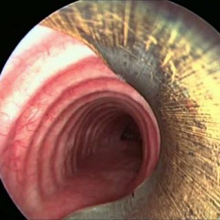 038 - Bronchoscope entering the trachea