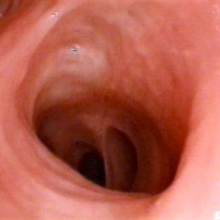 070 - Entry of the right lower lobe