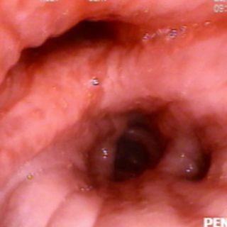 076 - Congestive edema of the mucosa