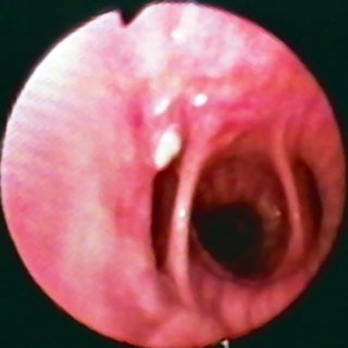 078 - View from the intermediate bronchus