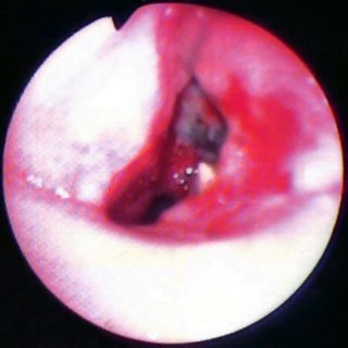159 - Gangliobronchial fistula