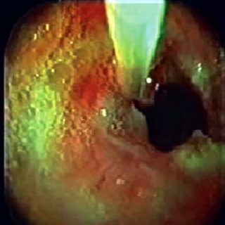 192 - Dilation of a tracheal stenosis