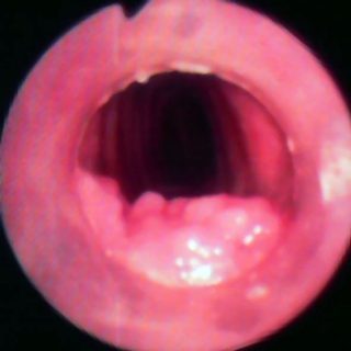 196 - Tracheal stent