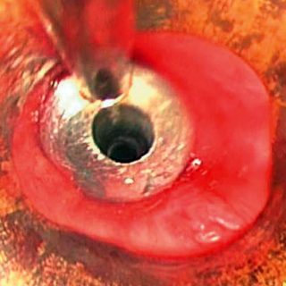 201 - Dilation of tracheal stenosis with metallic dilator