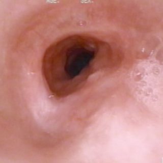 202 - Mucosa traqueal tras remoción de stent