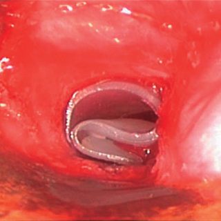 217 - Disposición en “omega” de un stent