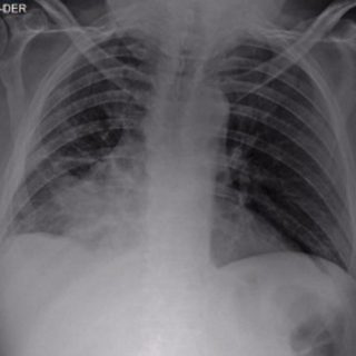 230 - Aneumatosis of the lower right lobe