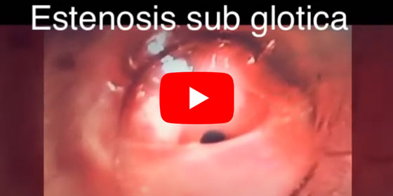Estenosis subglotica placement stent tracheal
