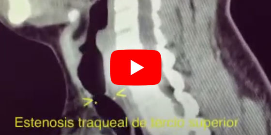 Stent traqueal